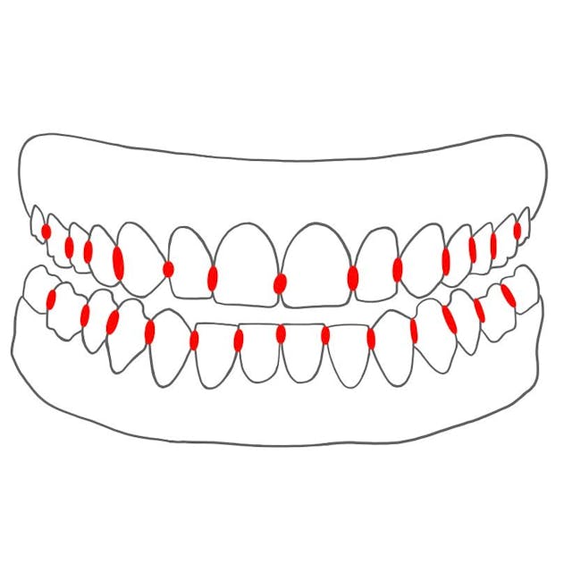 approximal   =   zum Nachbarzahn hin 

- alle Zähne / Kiefer