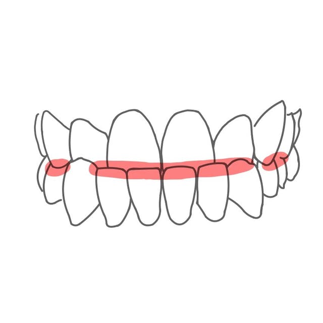 Kreuzbiss:

die Oberkieferzähne liegt nicht immer leicht über den Unterkieferzähnen, sondern die Zahnreihen kreuzen sich. Das kann in der Front oder seitlich passieren. 