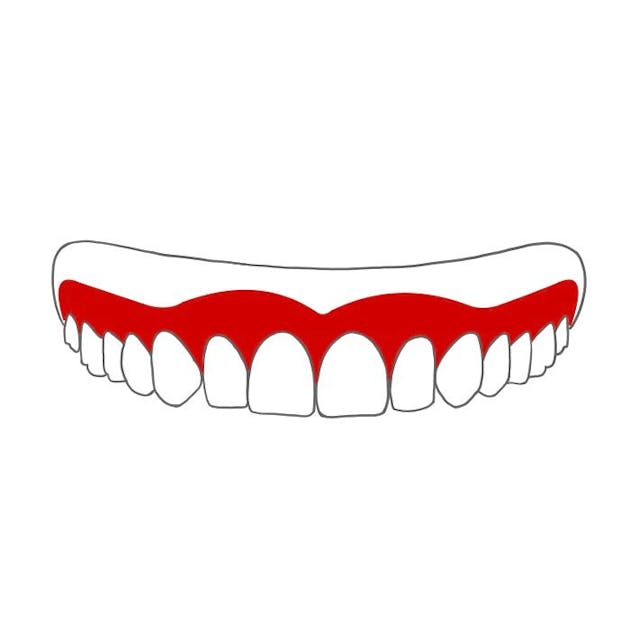 Totalprothese: 

ersetzt alle Zähne eines Kiefers.