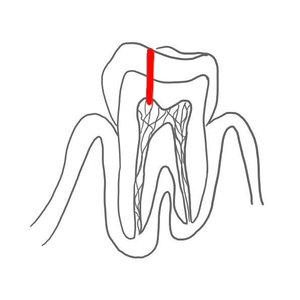 Im nächsten Stadium dringen die Bakterien in die Pulpa ein. 

Einmal im Zahnmark angelangt, wird die Pulpa durch Bakterien abgetötet. 