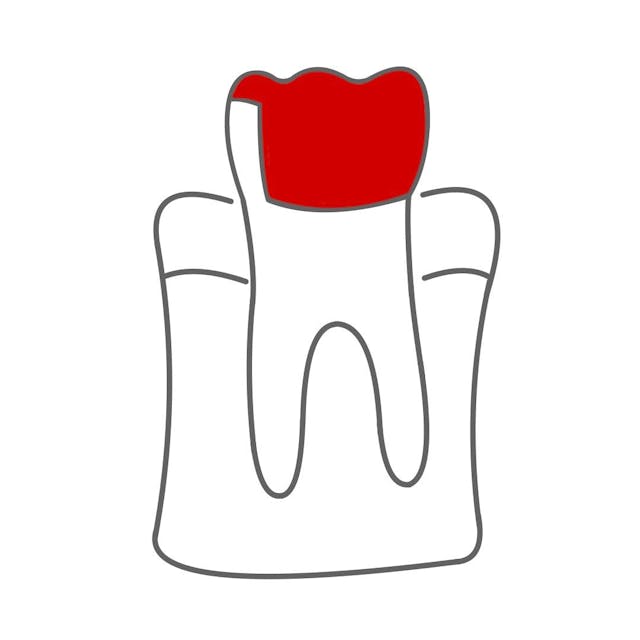 Teilkrone / partielle Krone:

der Zahn wird nur zu ungefähr 50-75% mit einer Krone überdeckt.
