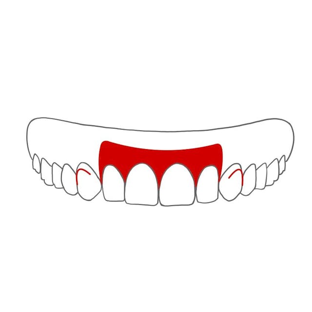 Teilprothese mit Klammern: 

wird an einzelnen, noch erhaltenen Zähnen befestigt.
