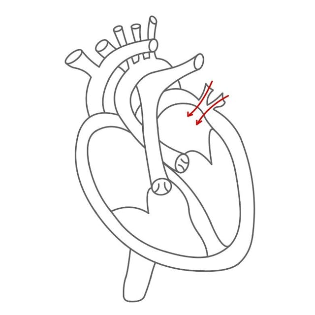 Linke Herzhälfte:

sauerstoffreiches Blut kommt über die Lungenvene in den linken Herzvorhof. 