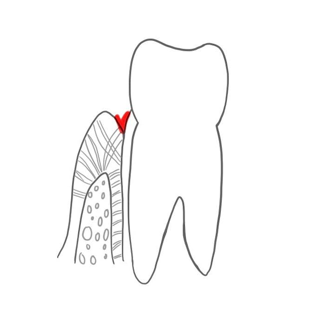 Zwischen dem Zahnfleisch und dem Zahn entsteht ein Raum, der als Sulkus (ca. 1-2 mm tief) bezeichnet wird.