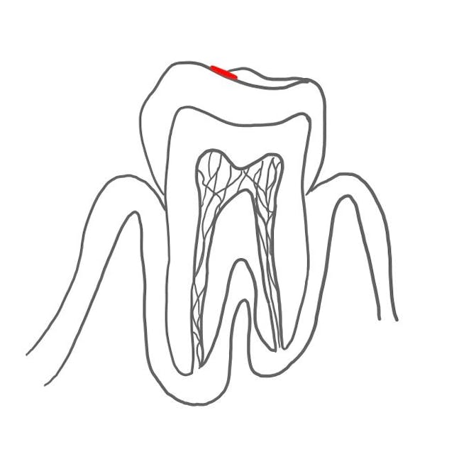 Initialkaries: 

der Zahnschmelz ist demineralisiert und white Spots (weiße Flecken) bilden sich. 