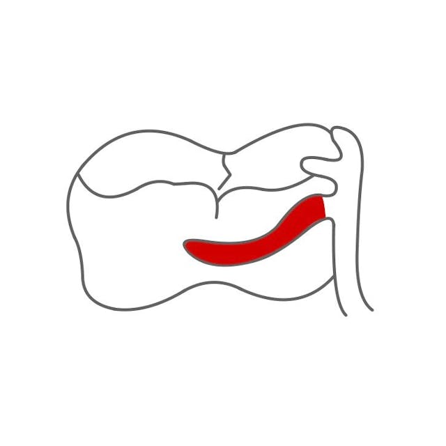 Um den Zahn gibt es Arme.

Der obere Anteil (Oberarm) schützt vor hin und her Bewegungen, der untere Anteil (Unterarm) vor ablösenden Kräften.