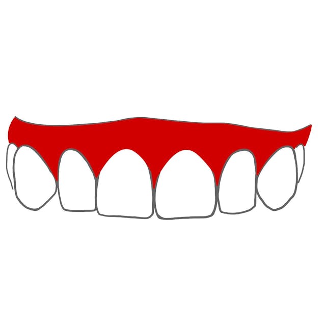 Hyperplasie: 

Zahnfleisch ist verdickt / mehr geworden.