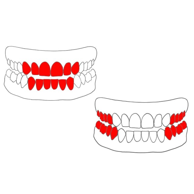 Der Frontzahnbereich umfasst die Schneidezähne & Eckzähne (3 bis 3). 

Der Seitenzahnbereich umfasst die Prämolaren & Molaren (4 bis 8). 