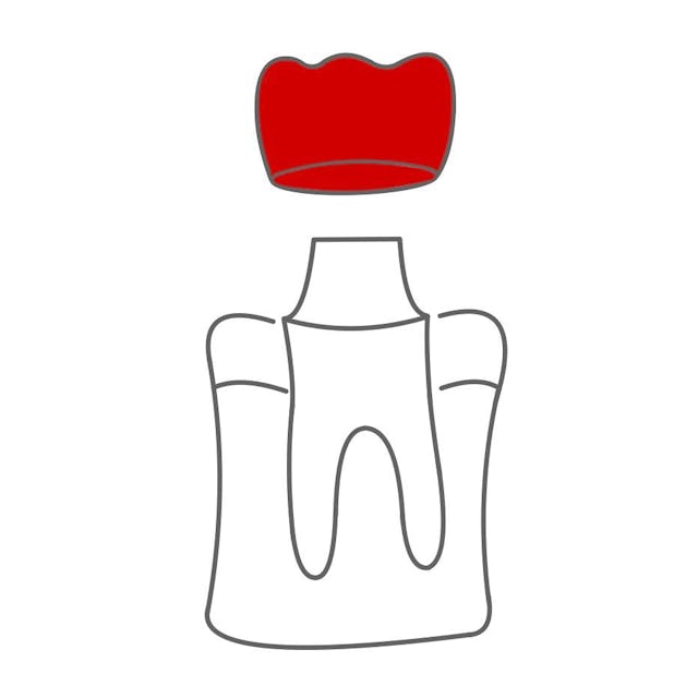 Krone:

eine Kappe, welche auf den Zahn gesetzt wird.