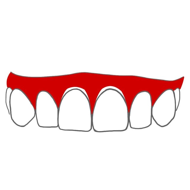 Rezession: 

das Zahnfleisch geht zurück, sodass der Zahnhals frei liegt und oft empfindlich wird.