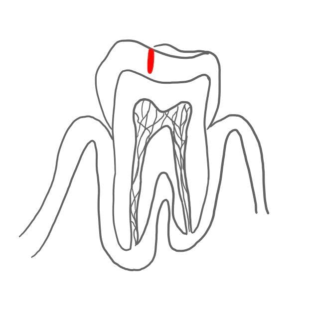 Schmelzkaries (caries superficialis): 

der Zahnschmelz bricht ein und Karies entsteht. 