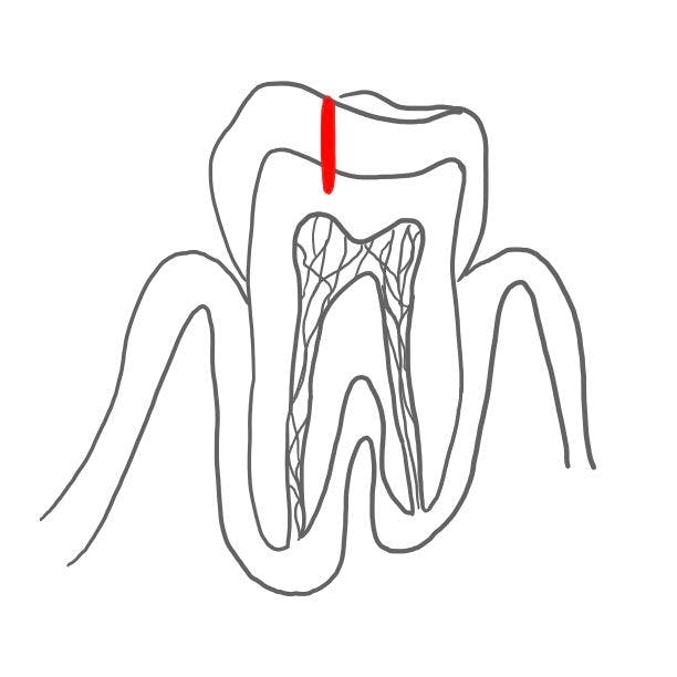 Dentinkaries (caries media): 

Kariesbakterien wandern über die Schmelz-Dentin-Grenze ins Dentin. Da das Dentin weicher ist, breitet sich die Karies dort schneller aus. 