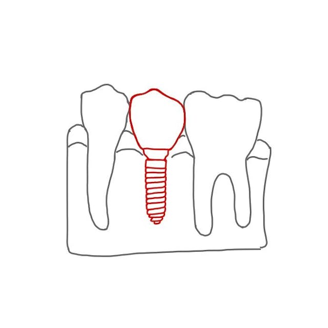 Implantate sind künstliche Zahnwurzeln, welche in den Knochen eingebracht werden.
