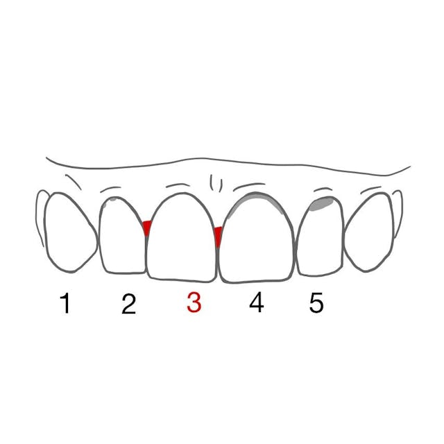 3: der gesamte Zahnzwischenraum füllt sich mit Blut