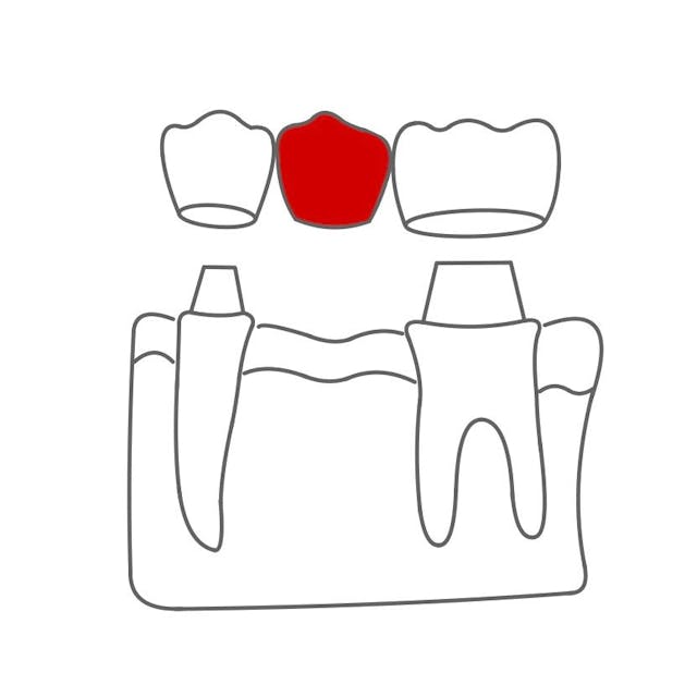 Die Brückenanker sind fest mit den Brückengliedern verbunden.

Diese liegen auf dem Kiefer und ersetzen einen oder mehrere Zähne.