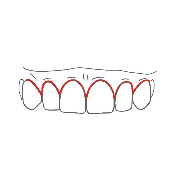 Direkt um den Zahn herum befindet sich die mariginale Gingiva. 

Sie ist verschieblich und nicht fest mit dem Zahn verbunden.