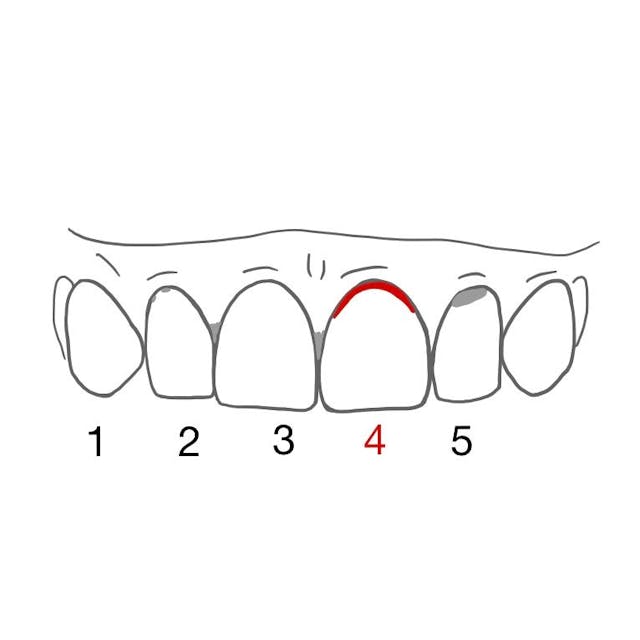 4: die Blutung geht am Zahnfleischrand entlang oder es sind mehrere
Blutungspünktchen vorhanden