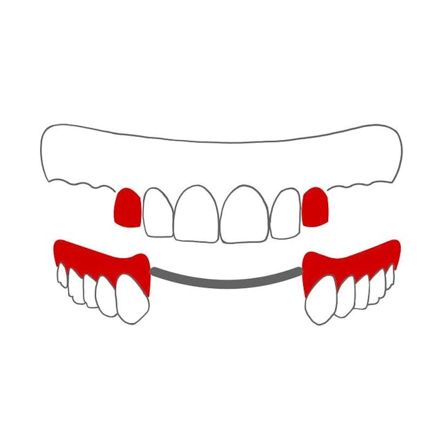 Teilprothese mit Teleskopen:

kleine Käppchen auf den Zähnen und eine Prothese zum herausnehmen.