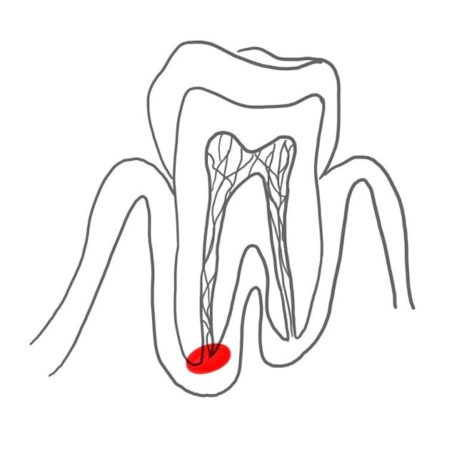 Apikale Parodontitis (Entzündung des Zahnhalteapparates an der Wurzelspitze): 

Toxine (Giftstoffe) & Krankheitserreger kommen aus dem Foramen apikale in das umliegende Gewebe. 


