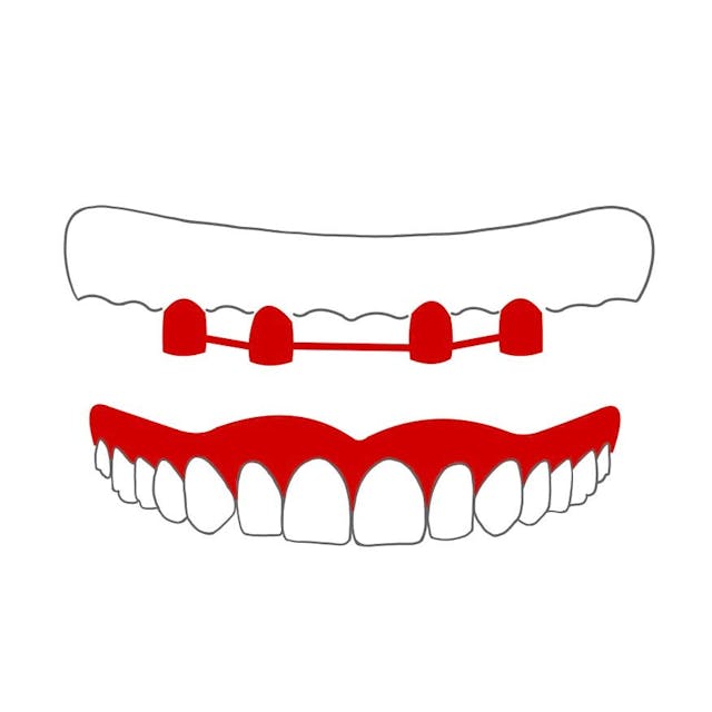Steg:

ein oder mehrere "Metallstäbe" werden zwischen den Zähnen fixiert.