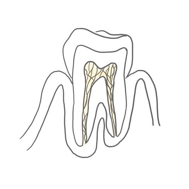 Pulpitis serosa (wässrige Zahnmarksentzündung): 

die Pulpa schwillt an, da mehr Serum (wässriger Bestandteil des Blutes) aus den Blutgefäßen ins Pulpagewebe kommt. 