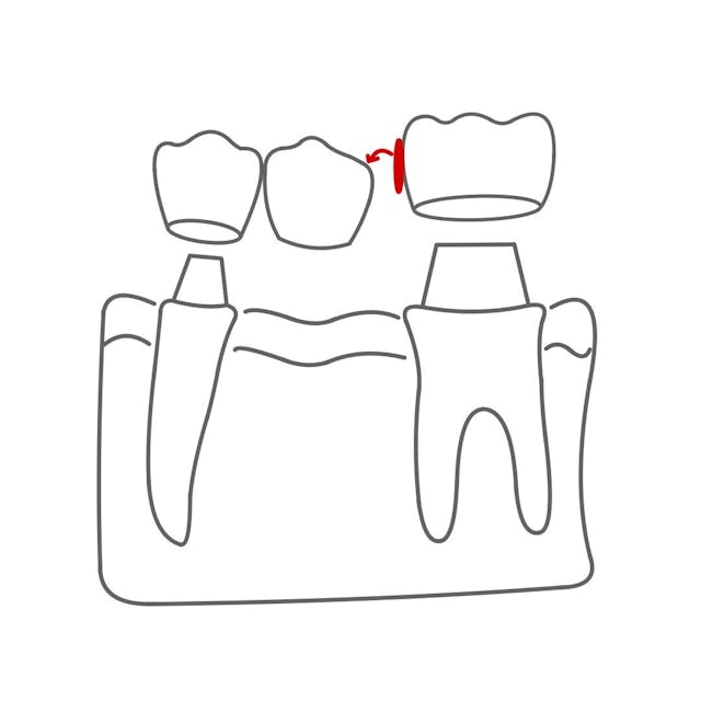 Ein Geschiebe besteht aus einer Patrize (kleiner Haken) und einer Matrize (Loch).

Diese werden an Brücke oder Zahn befestigt und ineinandergeschoben.