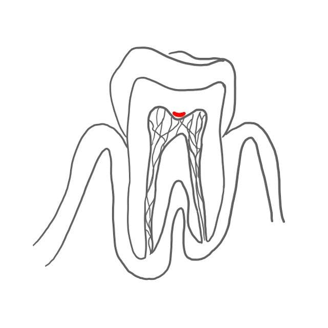 Für die indirekte Überkappung muss die Pulpa noch von einer Dentinschicht geschützt werden. 
