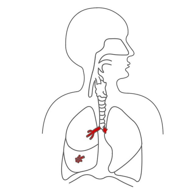 Zunächst gibt es 2 Hauptbronchien, die sich dann weiter in Bronchien zu Bronchiolen und zu vielen Lungenbläschen (Alveolen) aufteilen. 