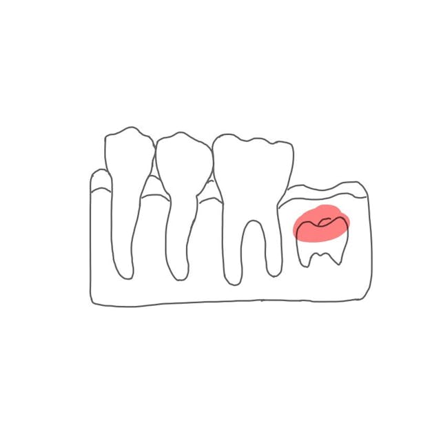 Follikuläre Zyste: 

ein folliculus (Zahnsäckchen) ist ein Zahn, der noch nicht vollständig ausgebildet wurde und noch im Knochen liegt. 
Die Zyste bildet sich im Kronenbereich des Follikels. 