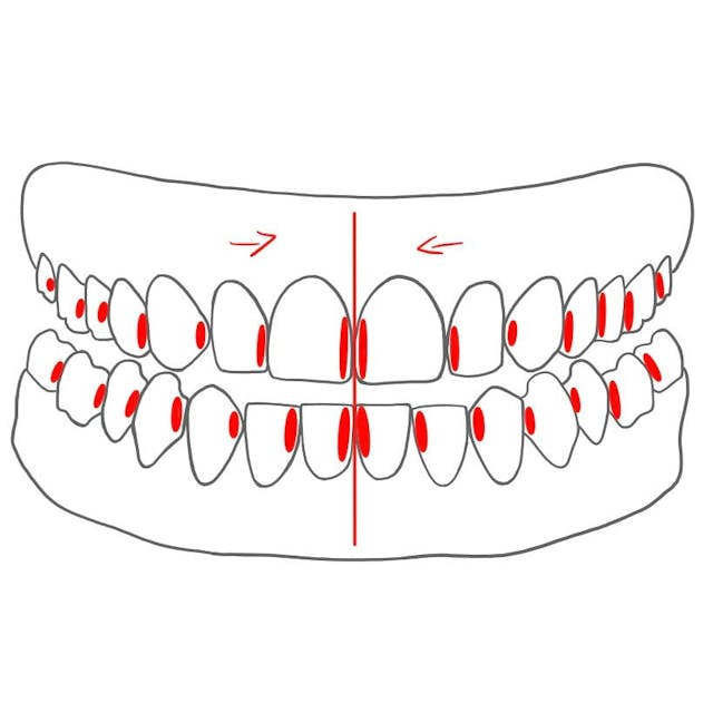 mesial (m)   =   zur Zahnbogenmitte hin

- alle Zähne / Kiefer