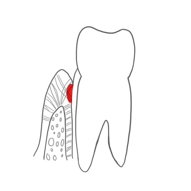 Um den Zahnhals herum ist das Saumepithel. Es heftet die Gingiva an die Zahnoberfläche.

Dies wird auch als Attachment (Befestigung) bezeichnet.