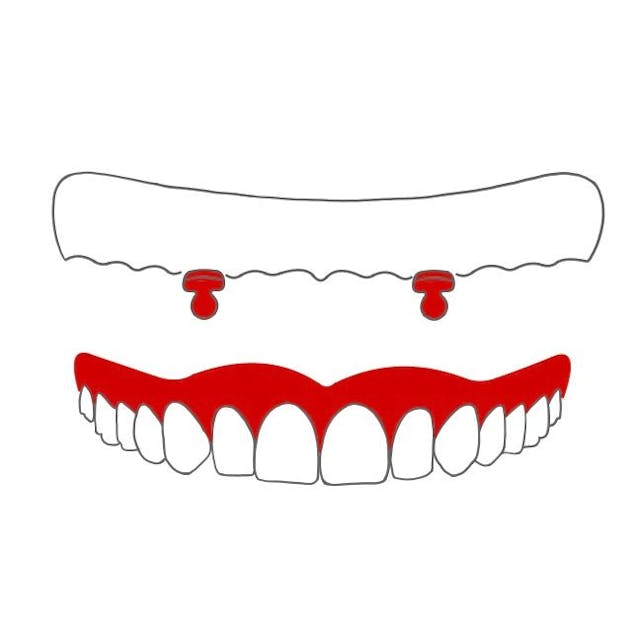 Knopfanker:

bei wurzelkanalbehandelten Zähnen wird ein Stift eingesetzt, welcher am oberen Ende eine Kugel hat.