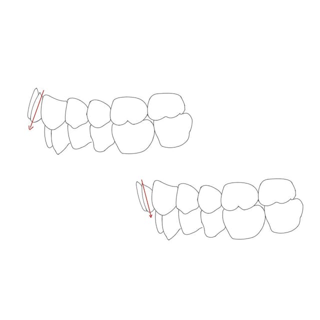 Bei einer protrudierten Front sind die Zähne zu weit nach vorne (pro = vor) und bei einer retrudierten Front (re = zurück) zu weit nach hinten gekippt.