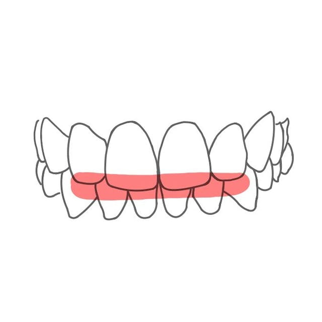Tiefer Biss:

die Oberkieferzähne überlappen die Unterkieferzähne in der Front um mehr als 2 mm.