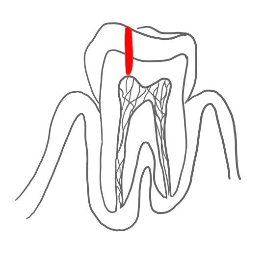 Tiefe Dentinkaries (caries profunda): 

die Karies gelangt immer tiefer, nur noch eine dünne Schicht Dentin schützt die Pulpa vor den Bakterien. 