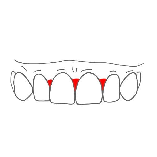 Die Zwischenräume sind mit sogenannten Interdentalpapillen ausgefüllt.

Sie schauen aus wie kleine Dreiecke zwischen den Zähnen.