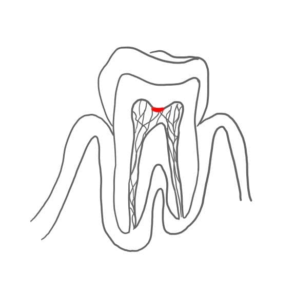 Eine direkte Überkappung wird benötigt, wenn die Pulpa schon punktuell eröffnet ist und Bakterien eindringen konnten.