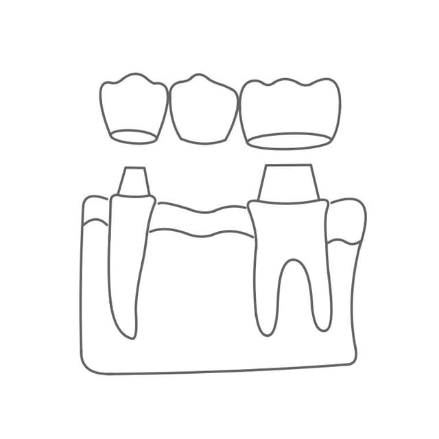 Brücke:
kleinere Zahnlücken können überbrückt werden.