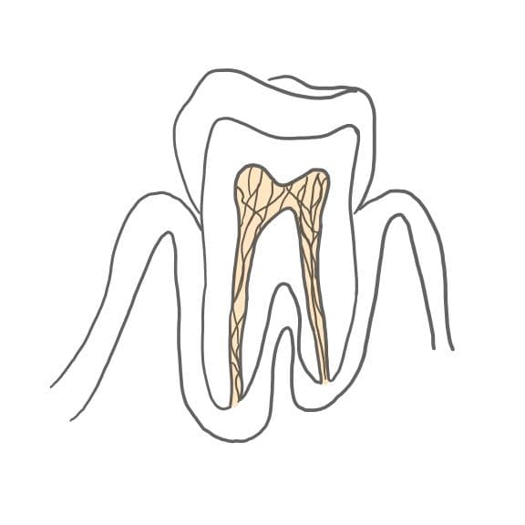 Pulpitis purulenta (eitrige Pulpitisentzündung): 
Leukozyten (weiße Blutkörperchen zur Abwehr) kommen vermehrt in die Pulpa. Dadurch kommt es zur Vereiterung der Pulpa und das Gewebe kann geschädigt werden.