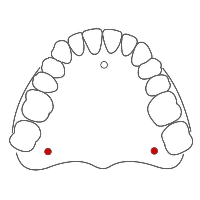 Foramen palatinum majus:
in Nähe der Weißheitszähne (8er).