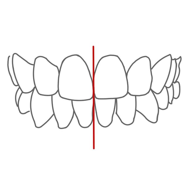 Beim zusammenbeißen ist die Mittellinie (zwischen den 1ern) von Ober- und Unterkiefer gleich.