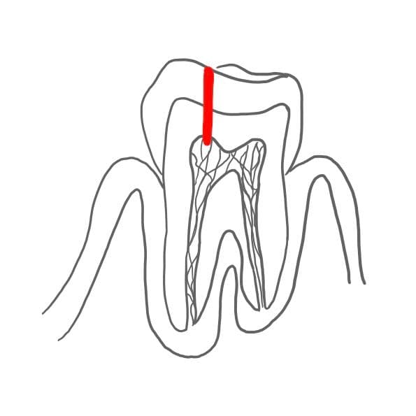 Im nächsten Stadium dringen die Bakterien in die Pulpa ein. 
Einmal im Zahnmark angelangt, wird die Pulpa durch Bakterien abgetötet.