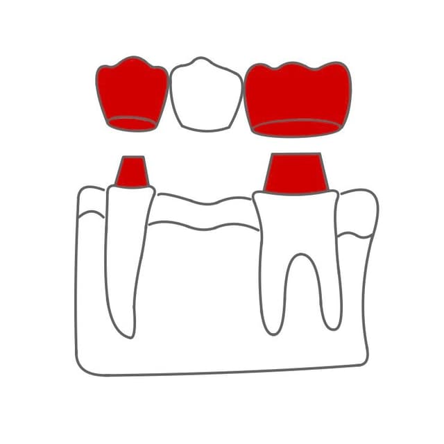 Eine Brücke enthält Kronen (Brückenanker), welche auf den präparierten Zähnen befestigt werden (Brückenpfeiler).