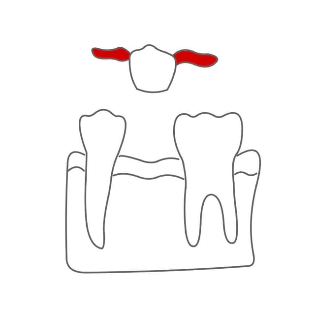 Inlaybrücke:
anstelle von Ankerkronen wird die Brücke mit Inlays an den Nachbarzähnen befestigt.