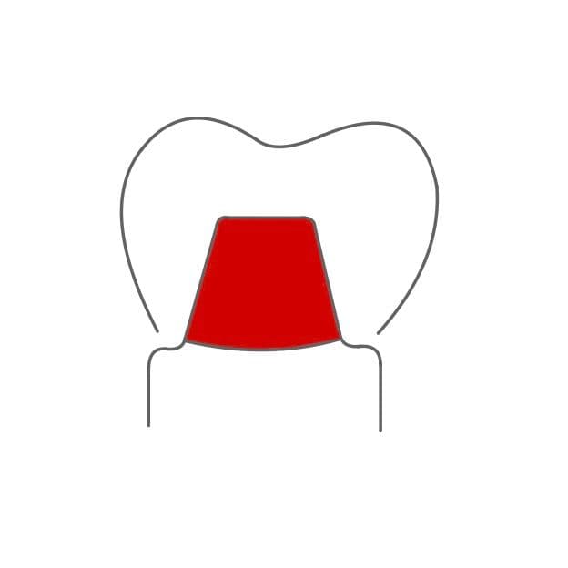 Konuskrone:
ist eher kegelförmig und besteht aus einem Primär- und einem Sekundärteleskop.