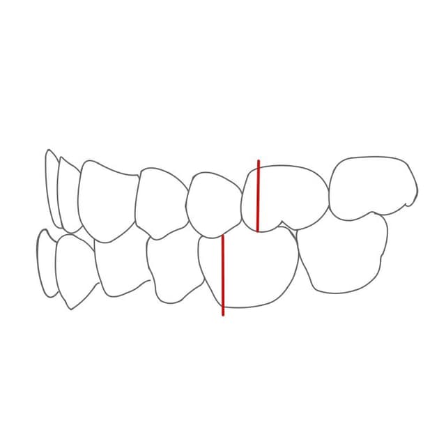 Mesialbiss (Progenie):
die Unterkieferzähne liegen mesial von den Regelbissmarken. Der Unterkiefer liegt also vor (=pro) dem Oberkiefer.