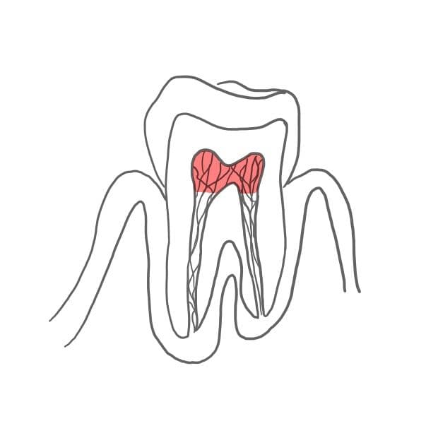 Die Pulpotomie wird gemacht, nachdem die Pulpa großflächig eröffnet wurde. 
Es sind schon viele Bakterien eingedrungen und die Pulpa zeigt eine ausgeprägte Entzündung.