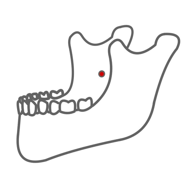 Foramen mandibulae:
um die Unterkiefer Molaren / Prämolaren zu betäuben.