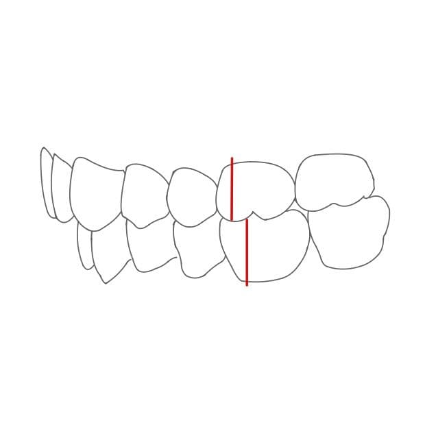 Distalbiss:
die Unterkieferzähne liegen distal von den Regelbissmarken, sind also zu weit hinten.