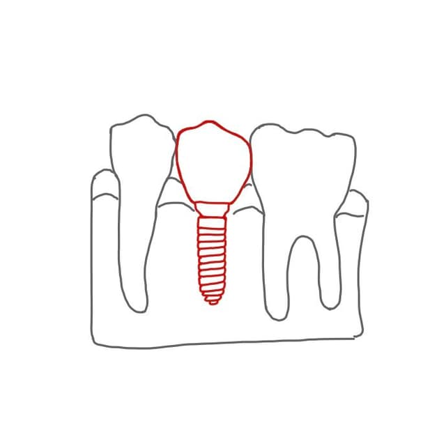 Implantate sind künstliche Zahnwurzeln, welche in den Knochen eingebracht werden.